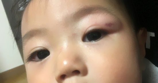70以上 赤ちゃん 目をこする 腫れる 116753赤ちゃん 目をこする 腫れる